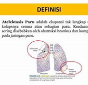 Ekspansi Paru Simetris Adalah Dalam Bahasa Indonesia